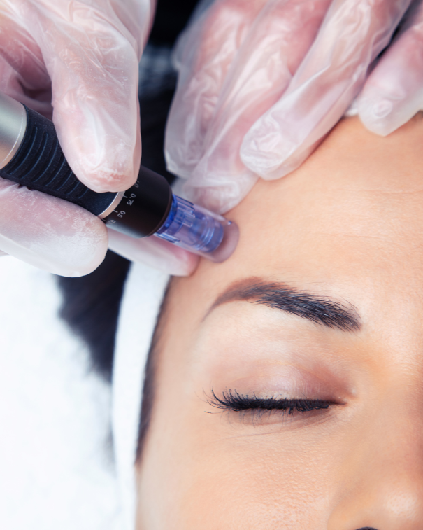 From Acne to Alopecia: Microneedling Magic