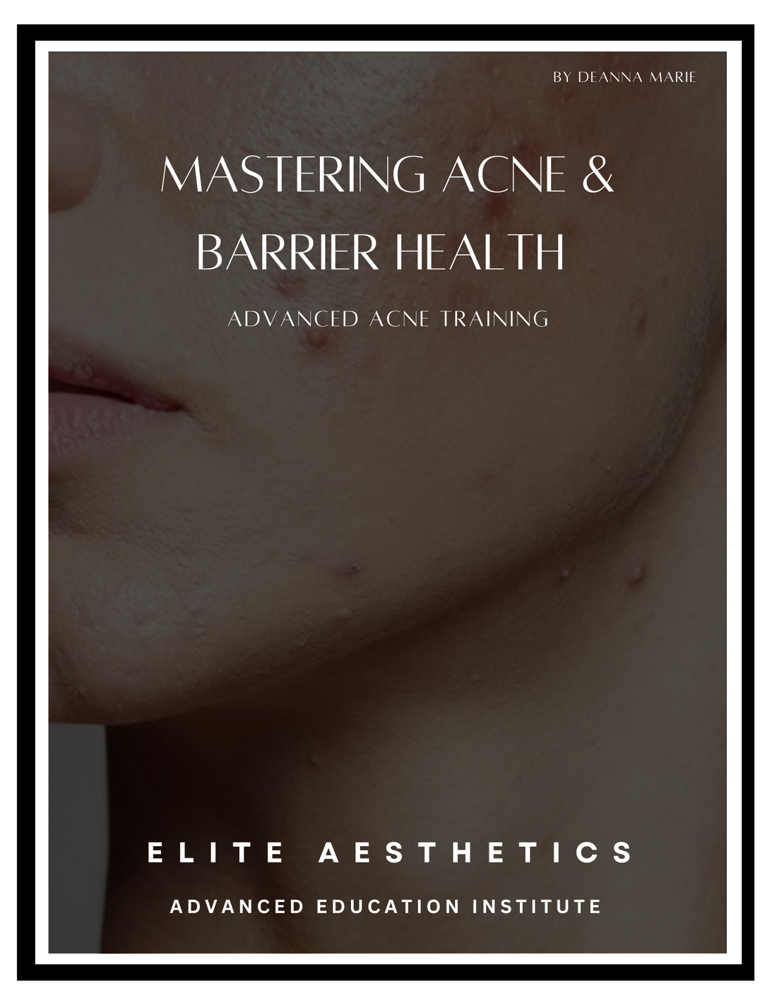 Mastering Acne & Barrier Health: Advanced Acne E-Book – Elite ...